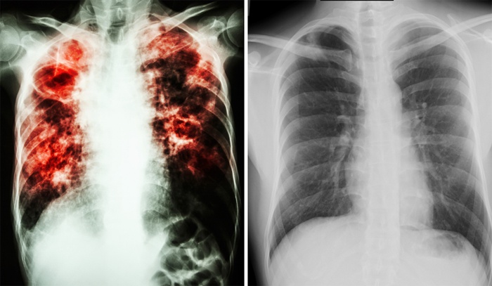 Результат пошуку зображень за запитом "туберкульоз"