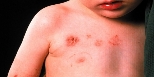 Инфекционный дерматит у ребенка или взрослого - причина заболевания, симптомы, диагностика и лечение