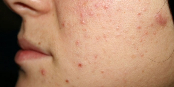 Прыщи на щеках у женщин - причина возникновения сыпи на лице