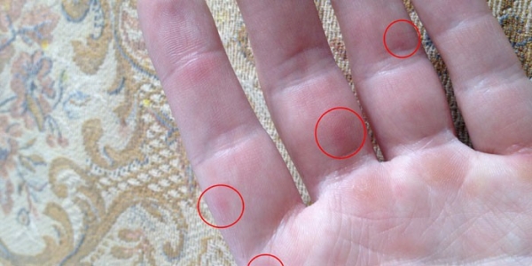Красные точки на руках у ребенка или взрослого - причины появления высыпаний
