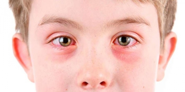 Глисты в глазах у человека - симптомы, пути заражения и лечение