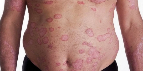 Сыпь на животе у ребенка, взрослого и беременной - причины появления на коже