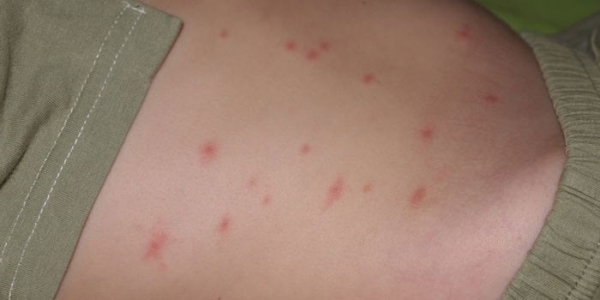 Сыпь на животе у ребенка, взрослого и беременной - причины появления на коже