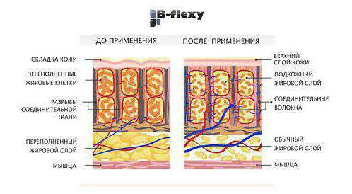 Массаж аппаратом B-flexy: отзывы
