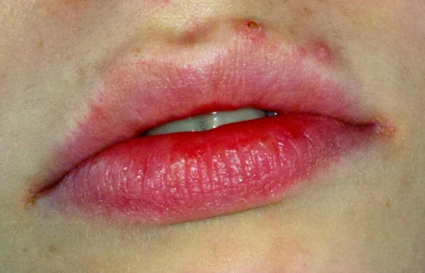 Прыщи на губах: фото, причины, лечение