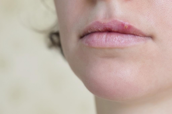 Прыщи на губах: фото, причины, лечение