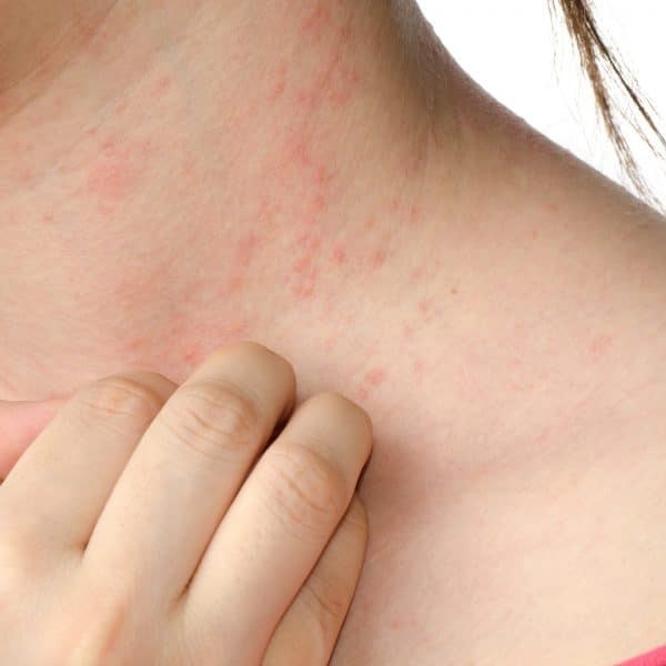 Мазь от аллергии на коже у взрослых: гормональные средства и другие препараты