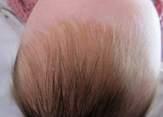Корочка на голове у ребенка 3 месяца