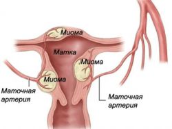 Миома матки - размеры для операции в миллиметрах