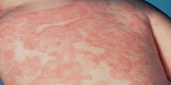Инфекционный дерматит у ребенка или взрослого - причина заболевания, симптомы, диагностика и лечение