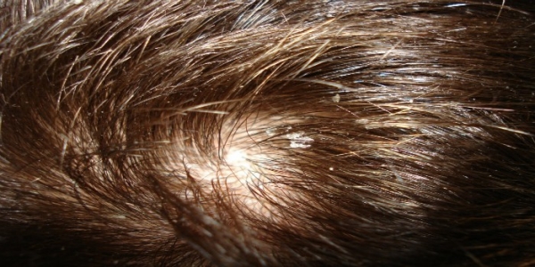Сухая себорея кожи головы и лица - симптомы и лечение шампунем, народными средствами и мазями