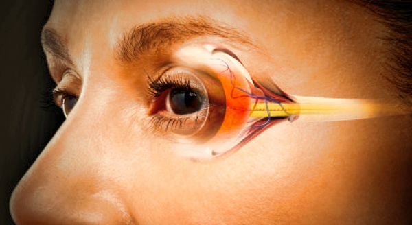 Как диагностировать и лечить глаукому