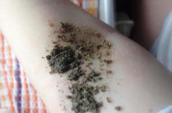 Как помочь себе в устранении синяка на теле