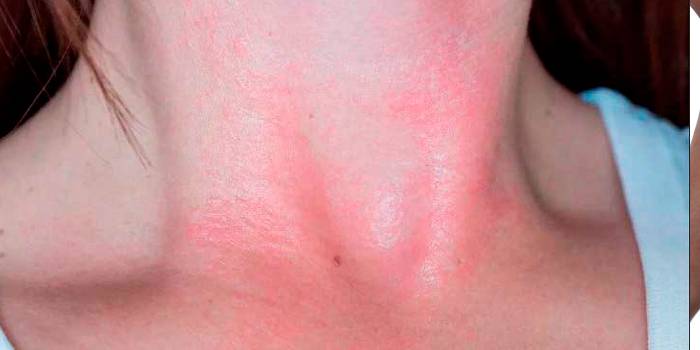 10 странных признаков аллергической реакции