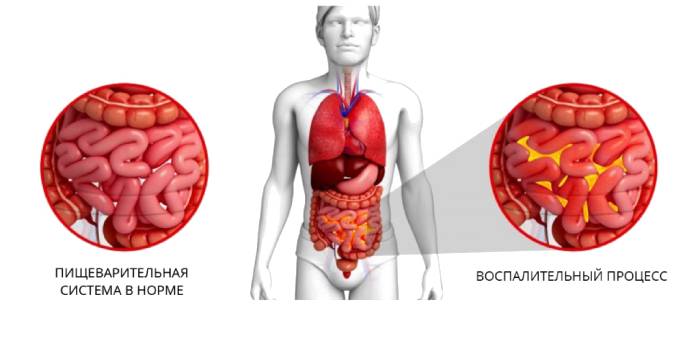 6 признаков, что у вас ишемия кишечника