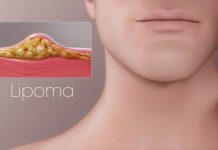 10 народних засобів, які допоможуть впоратися з жировиками