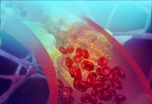 Лікарі назвали характерні ознаки початку розвитку атеросклерозу