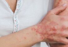 Вітамін D може полегшити протягом псоріазу — дослідження