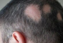 Експерти назвали новий варіант лікування однієї з форм раптового випадання волосся