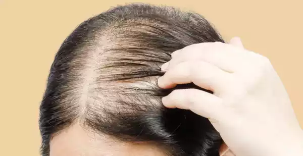 почему девушки страдают потерей волос