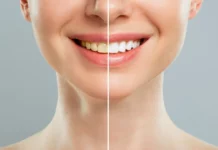 Тотальное протезирование зубов в клинике «Дантист»: полное восстановление улыбки без компромиссов