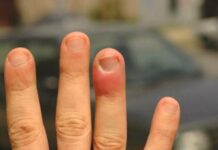 Як лікувати гній під нігтем домашніми засобами