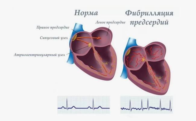 Как питаться при фибрилляции предсердий