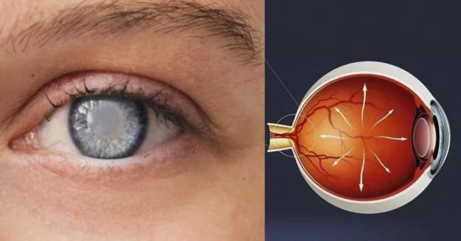 Может ли глаукома передаваться по наследству