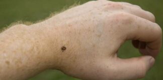 Чому після укусу кліща з’являється алергія на м’ясо