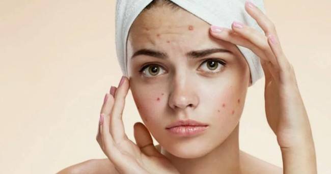 Почему летом чаще появляется акне