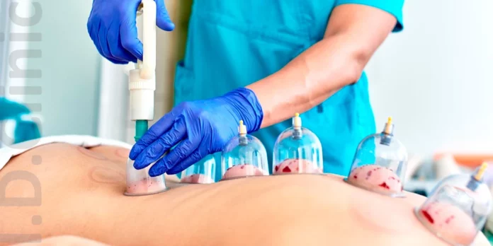 hijama_jpg