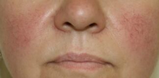 Як прибрати судинні зірочки на обличчі