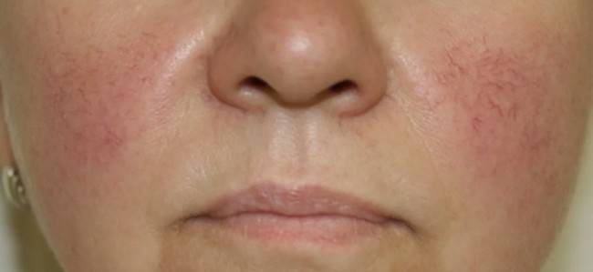 Как убрать сосудистые звездочки на лице