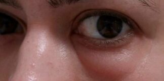 Приховані причини набряків під очима