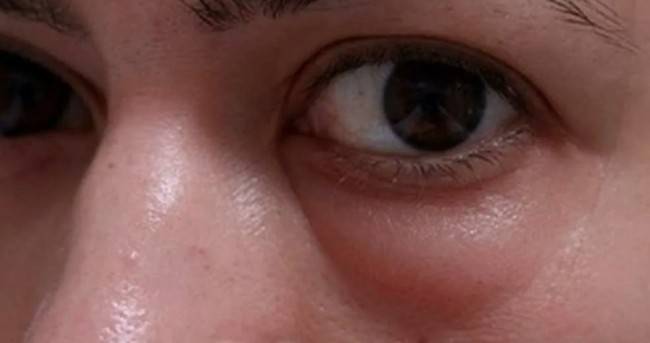 Скрытые причины отеков под глазами