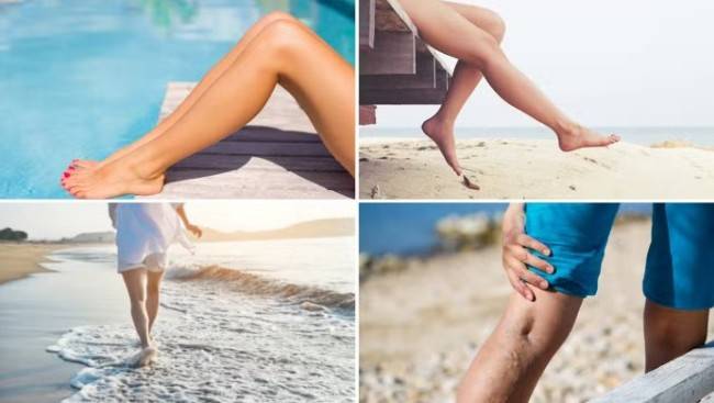 Усугубляет ли загар варикоз