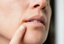 Як позбутися герпесу