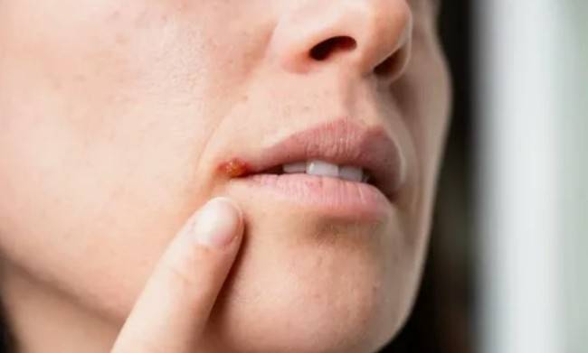 Как избавиться от герпеса
