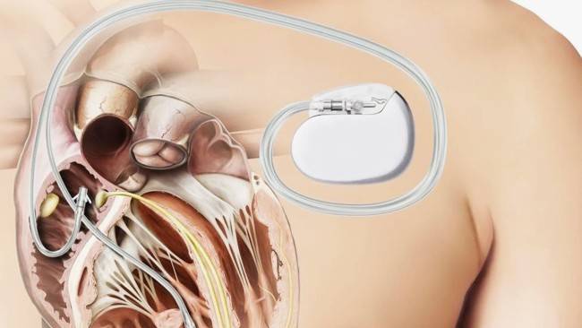 Когда необходимо поставить кардиостимулятор